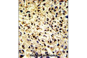 Formalin-fixed and paraffin-embedded human hepatocarcinoma with DCL-1 Antibody , which was peroxidase-conjugated to the secondary antibody, followed by DAB staining. (DCL1 anticorps  (AA 143-170))