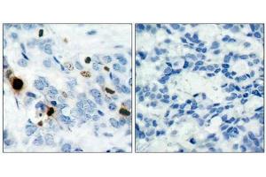 Immunohistochemical analysis of paraffin-embedded human breast carcinoma tissue using Histone H3. (HIST1H3A anticorps  (pSer10))