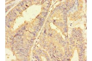 Immunohistochemistry of paraffin-embedded human endometrial cancer using ABIN7150164 at dilution of 1:100
