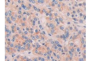 Detection of CHRD in Human Prostate cancer Tissue using Polyclonal Antibody to Chordin (CHRD)