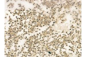 ABIN6259317 and ABIN6274541 at 1/100 staining human pituitary adenoma by IHC-P. (TRPS1 anticorps  (N-Term))