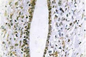 Immunohistochemistry (IHC) analyzes of Fes antibody in paraffin-embedded human liver carcinoma tissue. (FES anticorps)