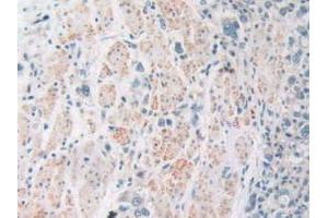 IHC-P analysis of Human Stomach Cancer Tissue, with DAB staining. (SIRT4 anticorps  (AA 28-314))