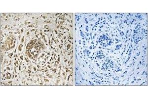 Immunohistochemistry analysis of paraffin-embedded human breast carcinoma tissue, using CIB2 Antibody. (CIB2 anticorps  (AA 21-70))