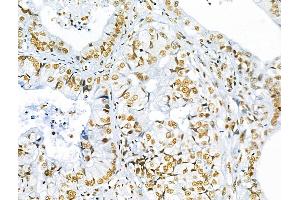 ABIN7093236 and ABIN7097248 at 1/100 staining Human lung cancer by IHC-P. (FOXO3 anticorps  (acLys271))