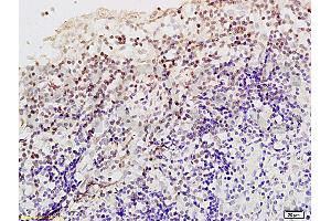 Formalin-fixed and paraffin embedded Human endometrium carcinoma labeled Anti-Livin Polyclonal Antibody, Unconjugated (ABIN672561) at 1:200, followed by conjugation to the secondary antibody and DAB staining (BIRC7 anticorps  (AA 101-200))