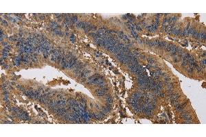 Immunohistochemistry of paraffin-embedded Human colon cancer tissue using KCNG1 Polyclonal Antibody at dilution 1:40