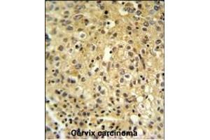 FYTD1 Antibody (N-term) (ABIN651416 and ABIN2840226) IHC analysis in formalin fixed and paraffin embedded human cervix carcinoma followed by peroxidase conjugation of the secondary antibody and DAB staining. (FYTTD1 anticorps  (N-Term))