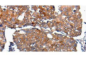 Immunohistochemistry of paraffin-embedded Human breast cancer using FGF2 Polyclonal Antibody at dilution of 1:100 (FGF2 anticorps)