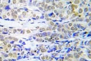 Immunohistochemistry (IHC) analyzes of FOXO4 antibody in paraffin-embedded human lung adenocarcinoma tissue. (FOXO4 anticorps)