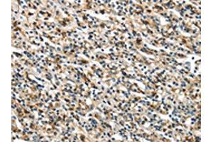 The image on the left is immunohistochemistry of paraffin-embedded Human prostate cancer tissue using ABIN7129612(GLP2R Antibody) at dilution 1/30, on the right is treated with fusion protein. (GLP2R anticorps)
