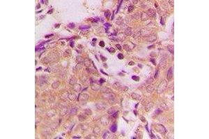 Immunohistochemical analysis of B3GALTL staining in human breast cancer formalin fixed paraffin embedded tissue section. (B3GALTL anticorps  (C-Term))