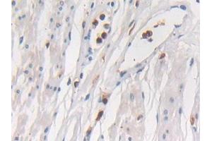 Detection of SEMA3E in Human Prostate Tissue using Polyclonal Antibody to Semaphorin 3E (SEMA3E)
