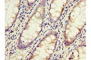 Immunohistochemistry of paraffin-embedded human colon cancer using ABIN7143229 at dilution of 1:100