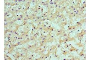 Immunohistochemistry of paraffin-embedded human liver cancer using ABIN7145593 at dilution of 1:100