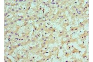 Immunohistochemistry of paraffin-embedded human liver cancer using ABIN7145593 at dilution of 1:100 (SULT2A1 anticorps  (AA 1-145))