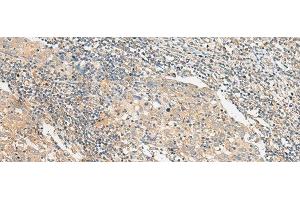 Immunohistochemistry of paraffin-embedded Human cervical cancer tissue using POLR2L Polyclonal Antibody at dilution of 1:45(x200)