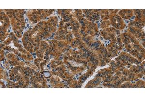 Immunohistochemistry of paraffin-embedded Human thyroid cancer using HSD3B7 Polyclonal Antibody at dilution of 1:40 (HSD3B7 anticorps)