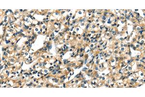 Immunohistochemistry of paraffin-embedded Human prostate cancer tissue using CK-17 Polyclonal Antibody at dilution 1:40