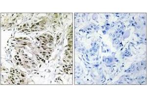 Immunohistochemistry analysis of paraffin-embedded human breast carcinoma, using CENPA Antibody. (CENPA anticorps  (AA 11-60))