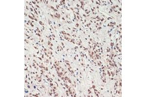 Immunohistochemistry of paraffin-embedded human gastric cancer using TDP-43/TARDB antibody (ABIN7270731) at dilution of 1:200 (40x lens). (TARDBP anticorps  (AA 1-260))