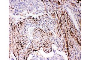 Anti-ADAM19 antibody, IHC(P) IHC(P): Human Lung Cancer Tissue (ADAM19 anticorps  (N-Term))