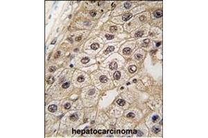 Formalin-fixed and paraffin-embedded human hepatocarcinoma tissue reacted with PERK antibody (N-term ) (ABIN392617 and ABIN2842134) , which was peroxidase-conjugated to the secondary antibody, followed by DAB staining.