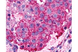 Anti-GPR116 antibody IHC of human Breast, Carcinoma. (G Protein-Coupled Receptor 116 anticorps  (N-Term))