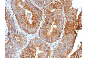 Formalin-fixed, paraffin-embedded human Colon Carcinoma stained with VEGI Rabbit Recombinant Monoclonal Antibody (VEGI /2052R). (Recombinant TNFSF15 anticorps)