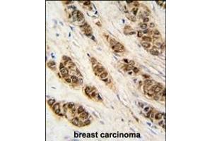 Formalin-fixed and raffin-embedded human breast carcinoma tissue reacted with XTP3T antibody (N-term), which was peroxidase-conjugated to the secondary antibody, followed by DAB staining.