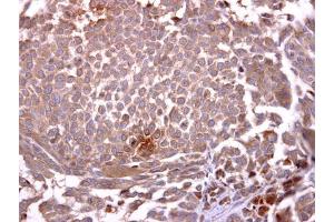 IHC-P Image Glycophorin A antibody [C1C3] detects Glycophorin A protein at cytosol on human lung carcinoma by immunohistochemical analysis. (CD235a/GYPA anticorps  (C-Term))