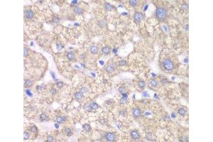 Immunohistochemistry of paraffin-embedded Human liver damage using ACAT1 Polyclonal Antibody at dilution of 1:100 (40x lens).
