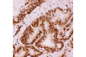Anti-ATF2 Picoband antibody,  IHC(P): Human Intestinal Cancer Tissue