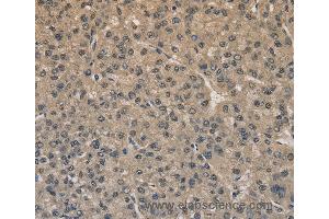 Immunohistochemistry of Human liver cancer using DRG1 Polyclonal Antibody at dilution of 1:20 (DRG1 anticorps)
