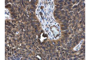 IHC-P Image FGD4 antibody [N1N3] detects FGD4 protein at cytoplasm in human lung cancer by immunohistochemical analysis. (FGD4 anticorps)