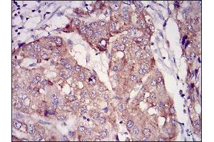Immunohistochemical analysis of paraffin-embedded liver cancer tissues using RAB27A mouse mAb with DAB staining.