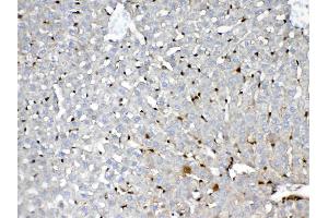 IHC analysis of GST3 / GST pi using anti-GST3 / GST pi antibody . (GSTP1 anticorps  (AA 2-210))