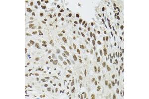 Immunohistochemistry of paraffin-embedded human lung cancer using SFPQ antibody. (SFPQ anticorps)
