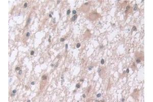 Detection of PSMa5 in Human Glioma Tissue using Polyclonal Antibody to Proteasome Subunit Alpha Type 5 (PSMa5)