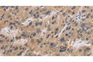 Immunohistochemistry of paraffin-embedded Human liver cancer tissue using CST6 Polyclonal Antibody at dilution 1:30