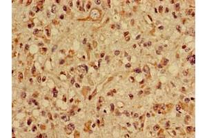 Immunohistochemistry of paraffin-embedded human glioma using ABIN7170144 at dilution of 1:100