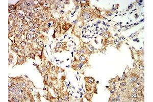 Immunohistochemical analysis of paraffin-embedded lung cancer tissues using KRT10 mouse mAb with DAB staining. (Keratin 10 anticorps  (AA 345-454))