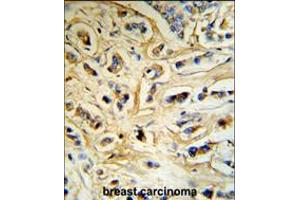 CASA Antibody (RB18742) IHC analysis in formalin fixed and paraffin embedded human breast carcinoma tissue followed by peroxidase conjugation of the secondary antibody and DAB staining. (Casein alpha S1 anticorps  (AA 42-70))
