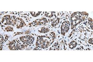 Immunohistochemistry of paraffin-embedded Human esophagus cancer tissue using ATAD1 Polyclonal Antibody at dilution of 1:65(x200) (ATAD1 anticorps)
