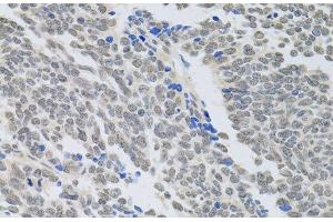 Immunohistochemistry of paraffin-embedded Human lung cancer using PAX3 Polyclonal Antibody at dilution of 1:100 (40x lens). (Paired Box 3 anticorps)