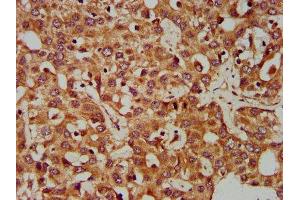 IHC image of ABIN7147569 diluted at 1:400 and staining in paraffin-embedded human liver cancer performed on a Leica BondTM system. (CLCC1 anticorps  (AA 446-551))