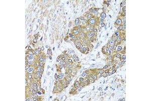 Immunohistochemistry of paraffin-embedded human prostate cancer using PEX14 antibody.