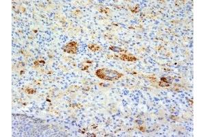 Formalin-fixed, paraffin-embedded human Erdheim Chester disease (also known as polyostotic lerosing histiocytosis) stained with TNF alpha antibody (TNFA/1172). (TNF alpha anticorps)