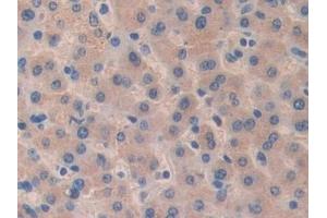 Detection of SEMA3A in Human Liver cancer Tissue using Polyclonal Antibody to Semaphorin 3A (SEMA3A)