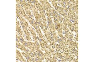 Immunohistochemistry of paraffin-embedded Human liver injury using ATP5B antibody at dilution of 1:100 (x400 lens). (ATP5B anticorps)